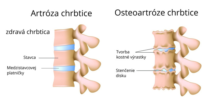 Artróza chrbtice