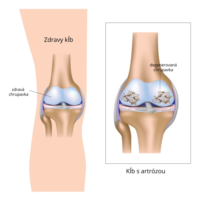 Artróza kolenného kĺbu