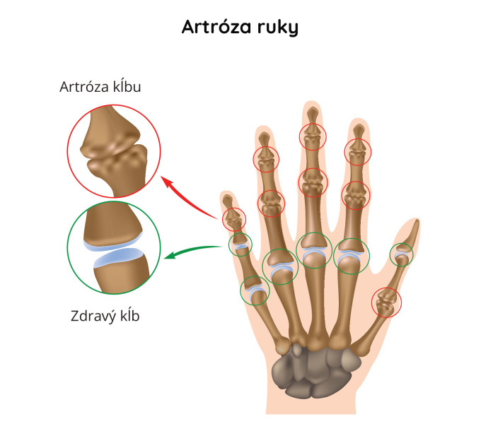 Artróza prstov na ruke 