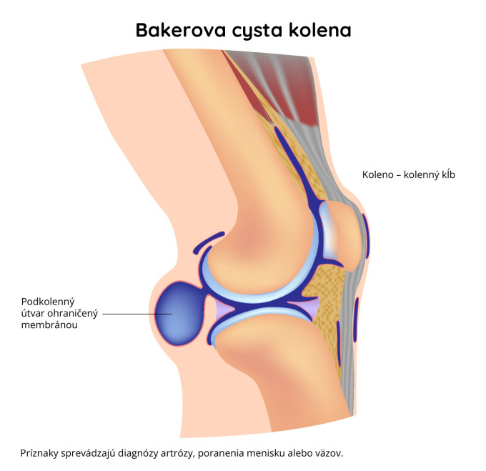 Bakerova cysta kolena