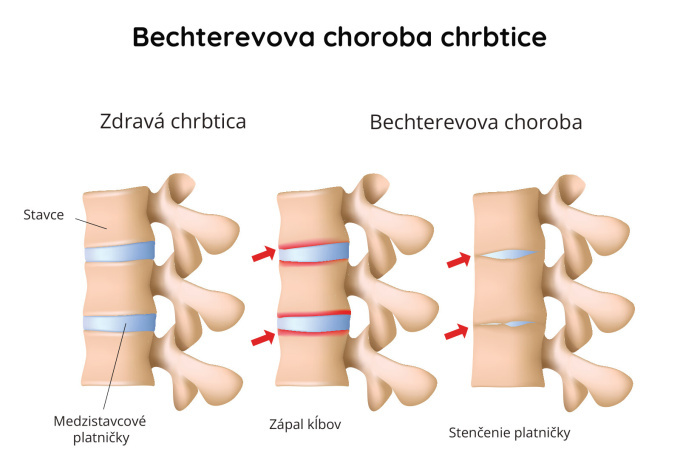 Bechterevova choroba chrbtice