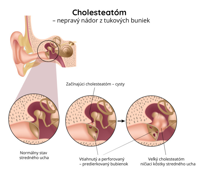 Cholesteatóm 