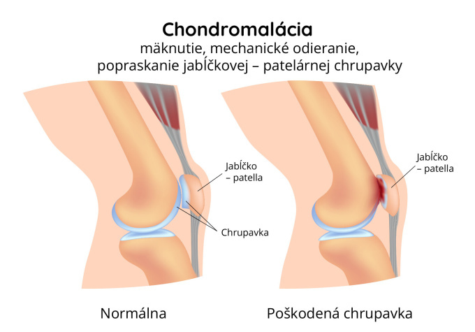 Chondromalácia jabĺčka 