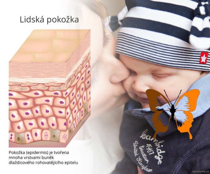 Choroba motýlích krídel