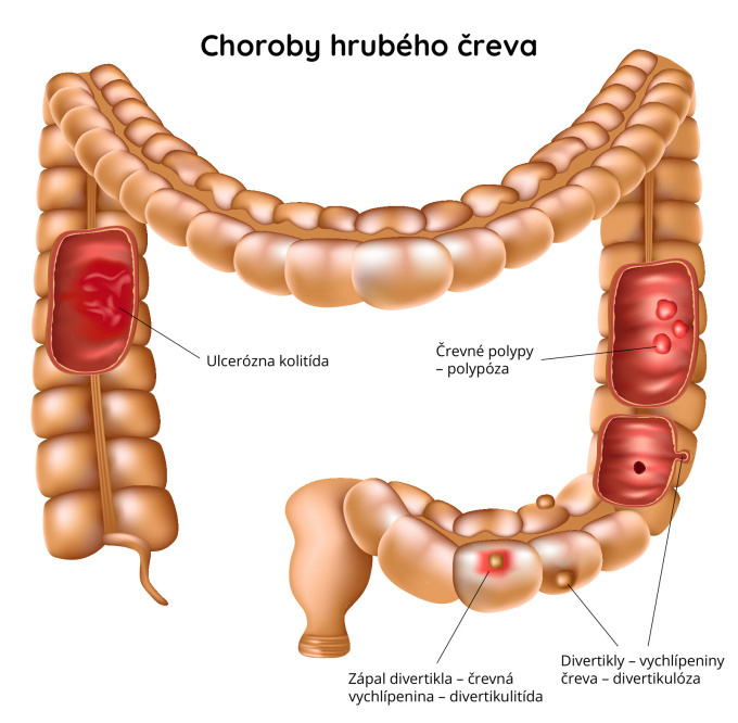 Choroby hrubého čreva