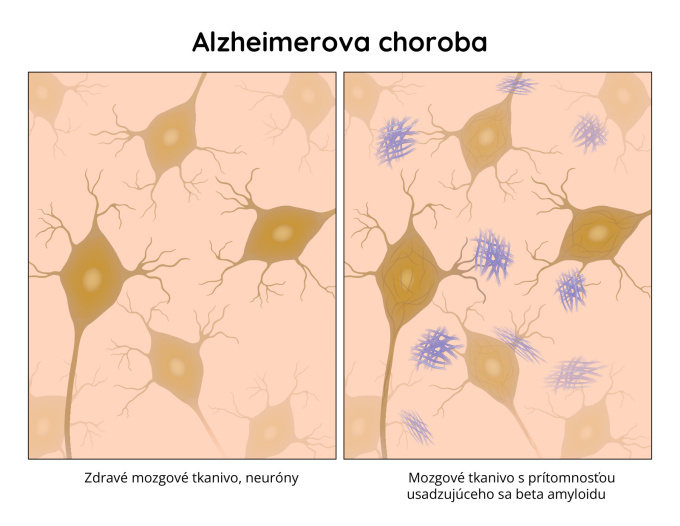 Alzheimerova choroba obraz