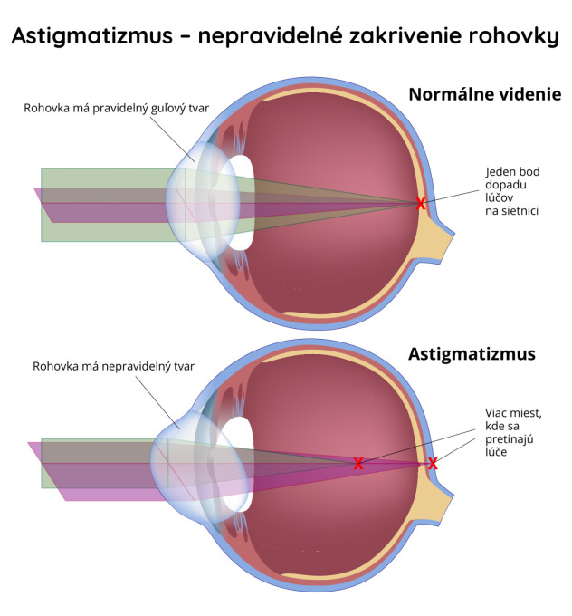Astigmatismus - nepravidelné zakrivenie rohovky
