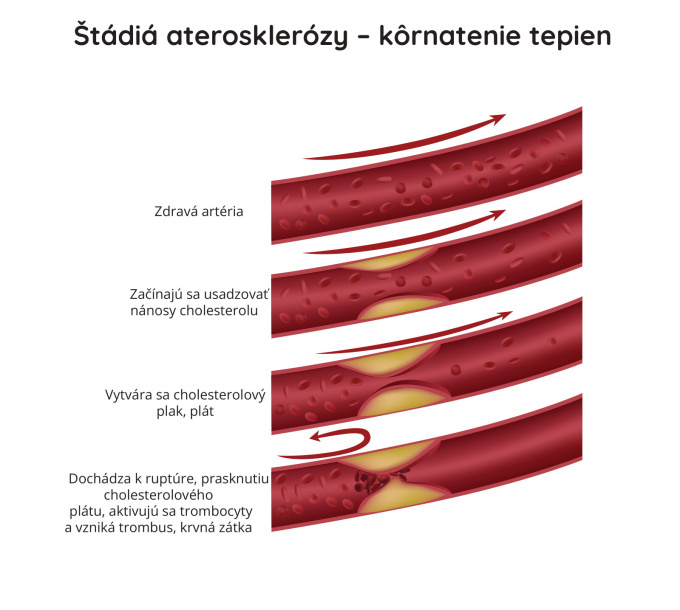 Štádia aterosklerózy - kôrnatenie tepien