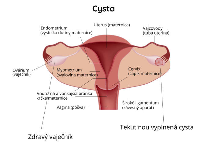 Cysta