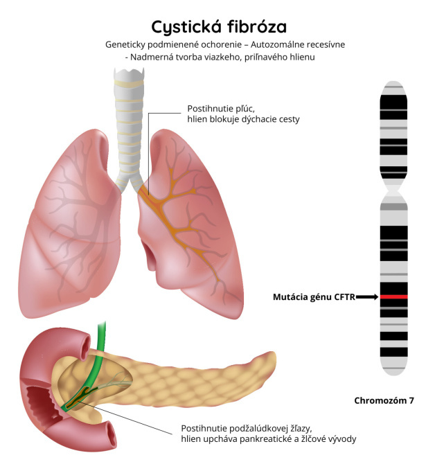 Cystická fibróza