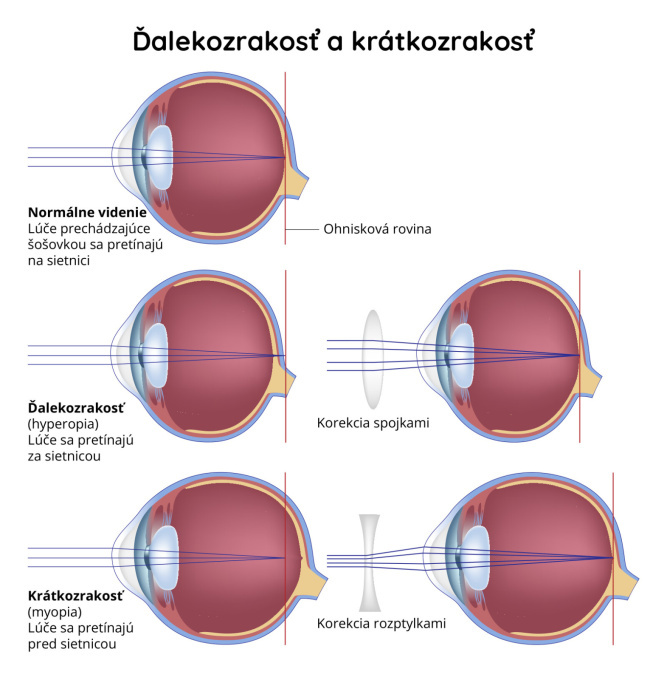 Ďalekozrakosť a krátkozrakosť