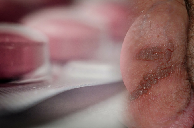 Genitálny herpes pohlavni choroba