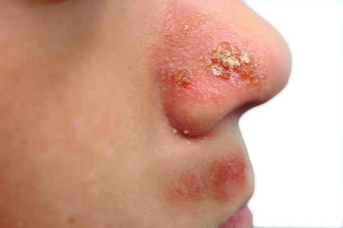 Impetigo-pod-nosem