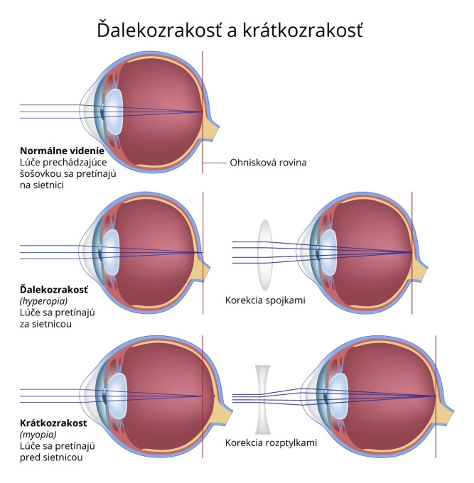 Krátkozrakosť