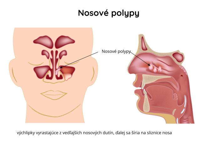 Nosové-polypy