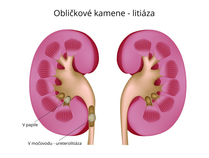 Obličkové kamene
