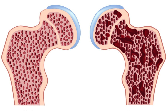 Rednutie-kosti-osteoporoza