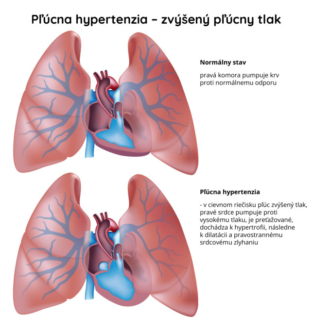 Pľúcna-hypertenzia