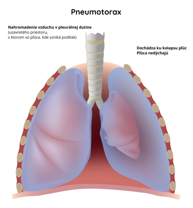 Pneumotorax---nahromadenie-vzduchu-v-pleurálnej-dutine