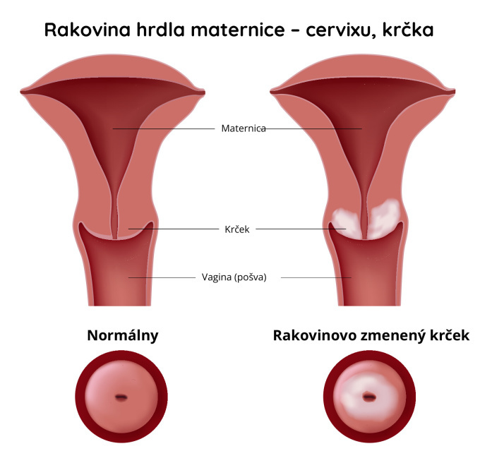 Rakovina-krčka-maternice