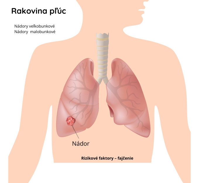 Rakovina pľúc
