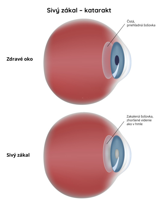 Šedý-zákal----katarakt
