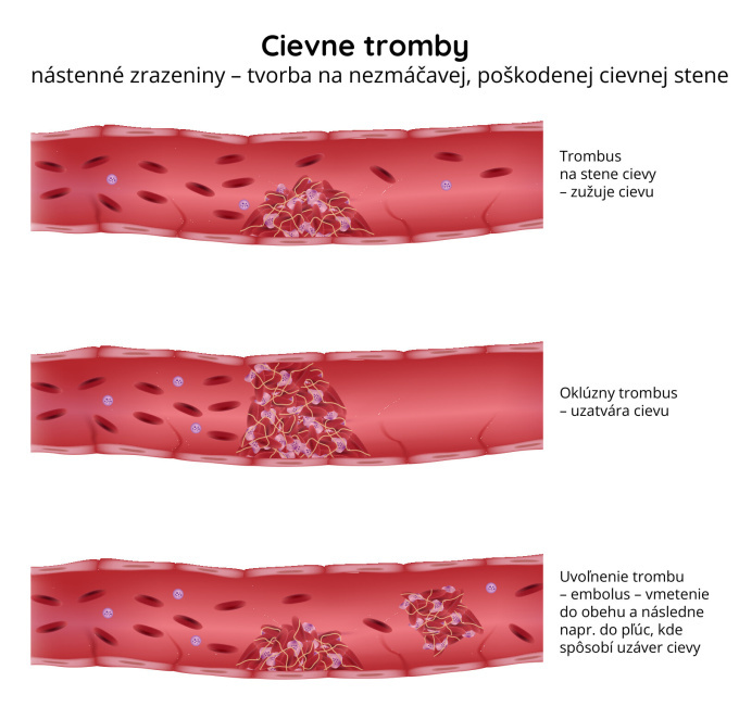 Cievne-tromby-trombóza