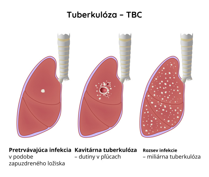 Tuberkulóza (TBC)