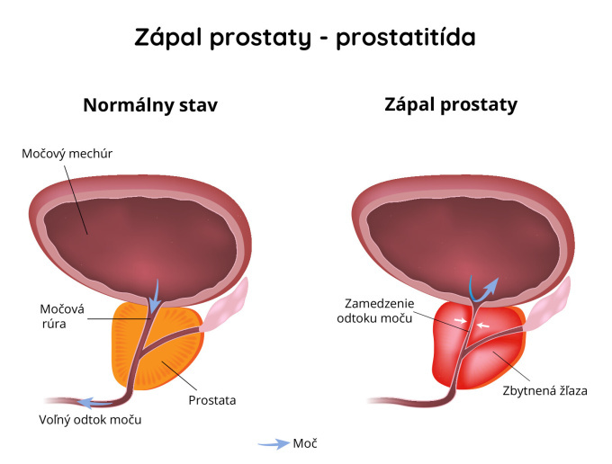 Zápal prostaty (prostatitída)