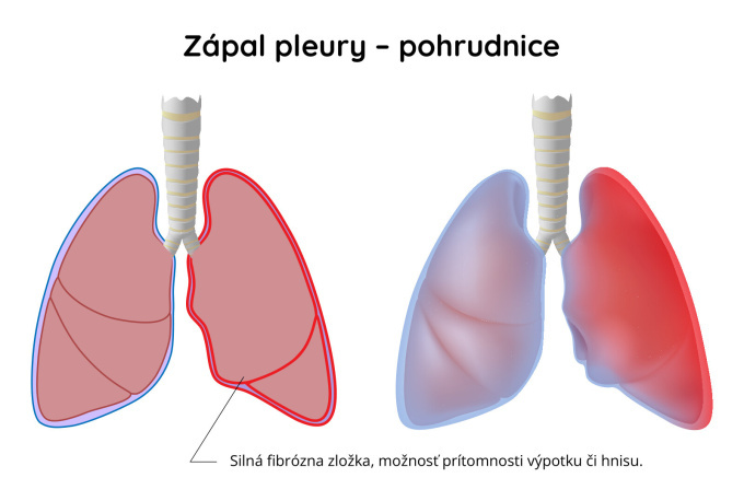 Zápal-pohrudnice