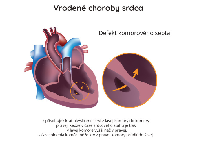 Defekt komorového septa
