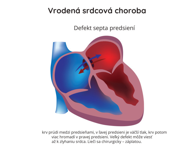Defekt predsieňovej priehradky (ASD)