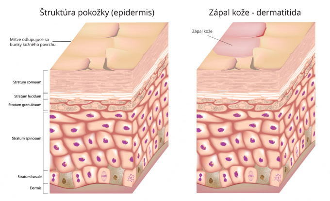 Dermatitída
