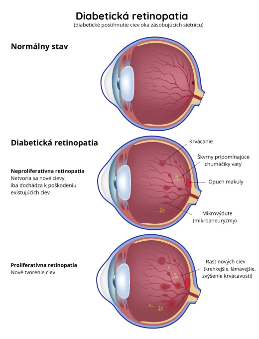 Diabetická retinopatia