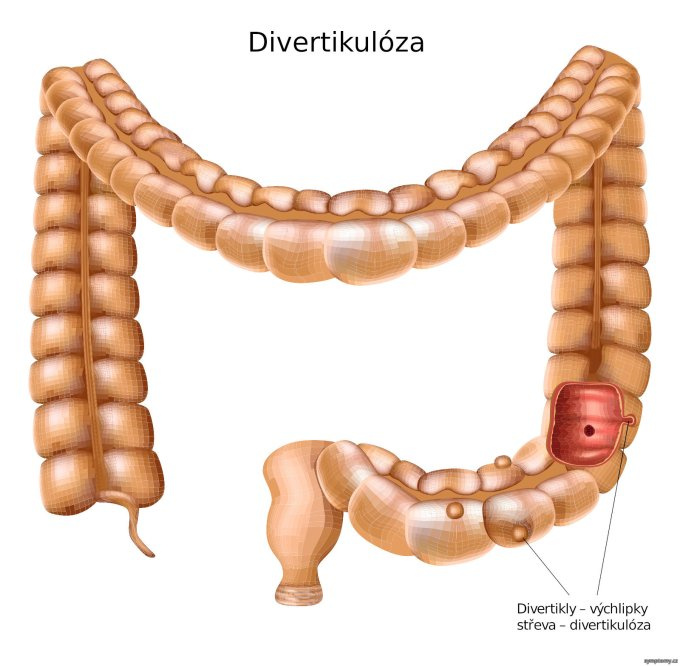 Divertikulóza