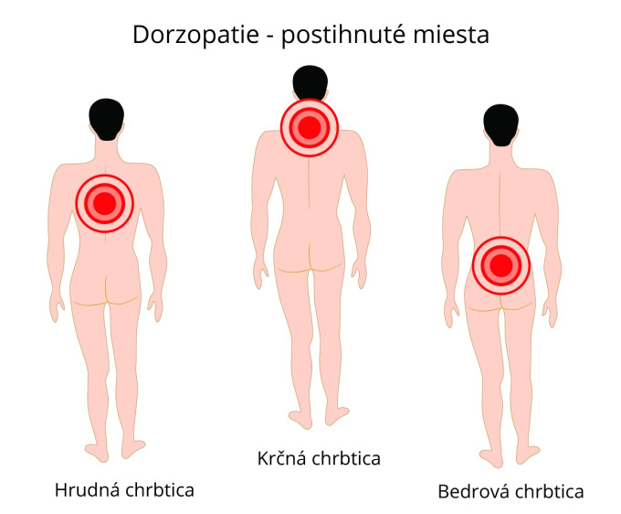 Dorzopatie