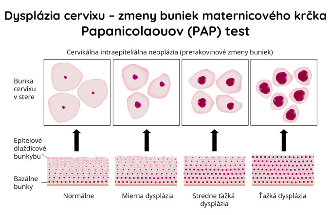 Dysplázia krčka maternice 
