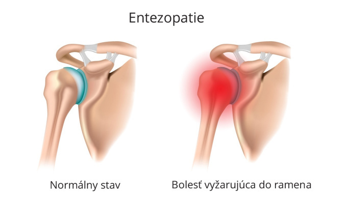 Entezopatia