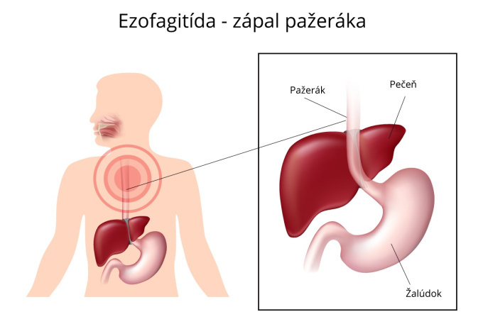 Ezofagitída