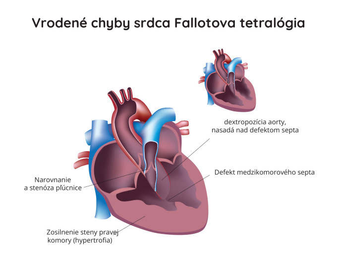 Fallotova tetralógia