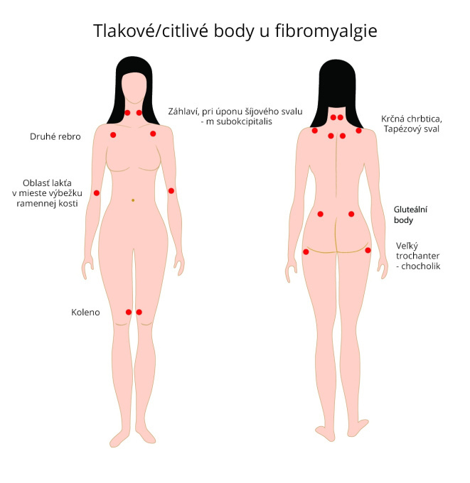 Tlakové - citlivé body u fibromyalgie