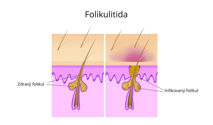 Folikulitída