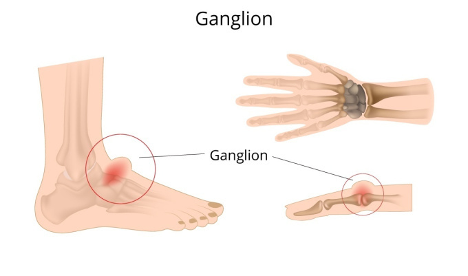 Ganglion na ruky a nohe