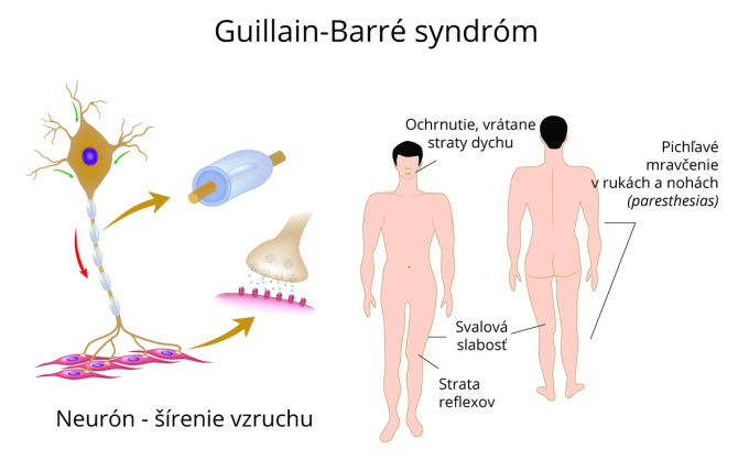 Guillain-Barré syndrom