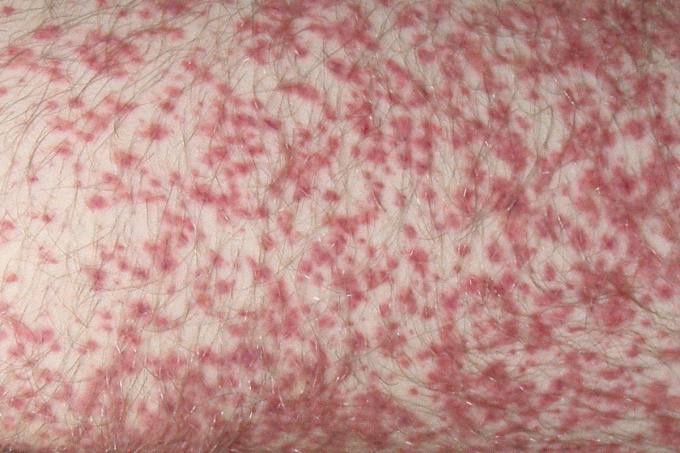 Henochova (-Schönleinova) purpura