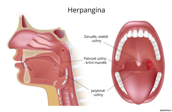 Herpangína