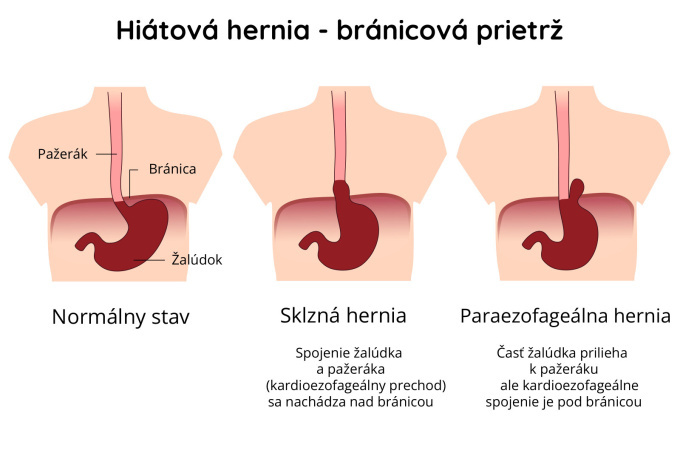 Hiátová hernia