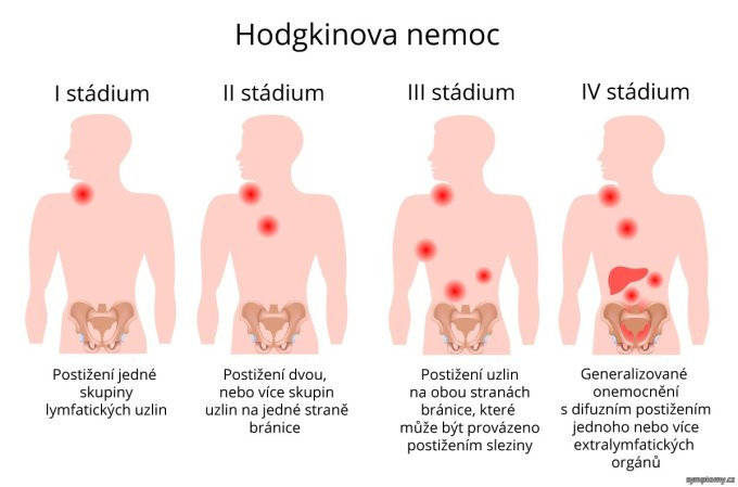 Hodgkinova choroba
