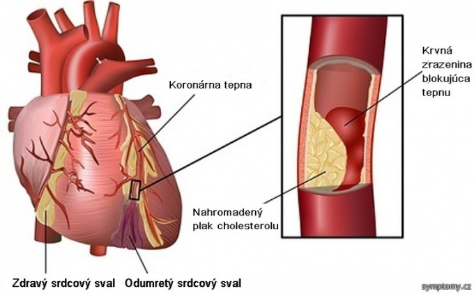 Infarkt myokardu