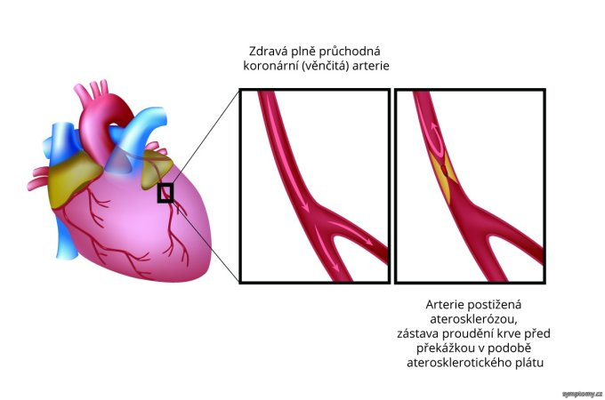 Ischemická choroba srdca